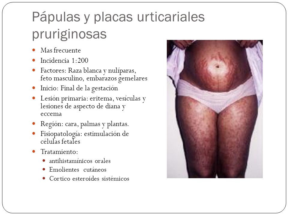 Kupchino el s. a. El tratamiento de la psoriasis